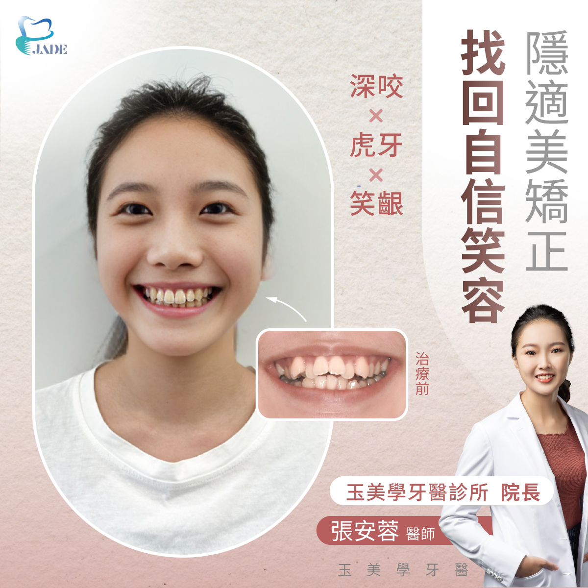 隱適美找回自信笑容，深咬、虎牙、笑齦治療前後從凌亂變整齊