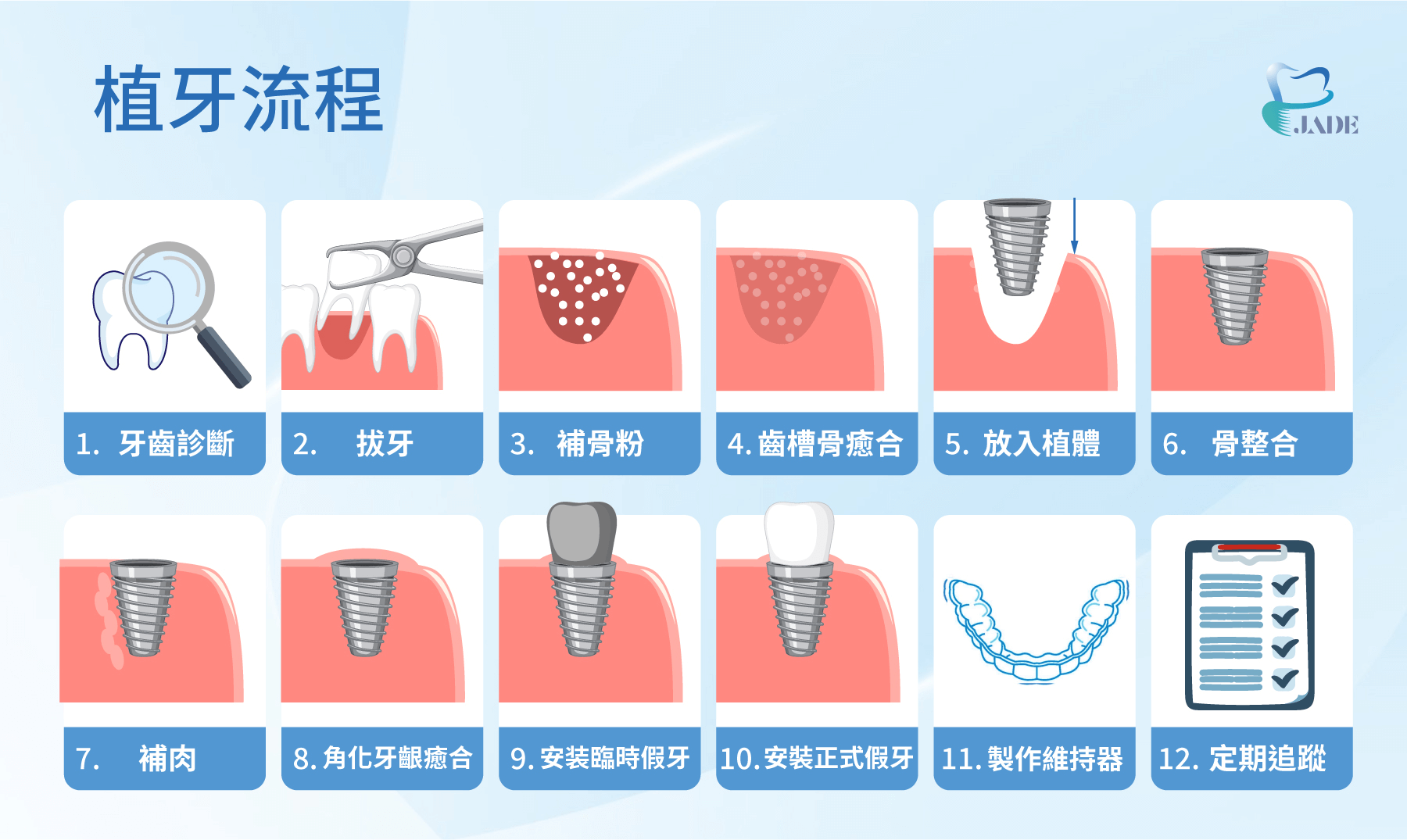 植牙流程圖，總共有十二個步驟