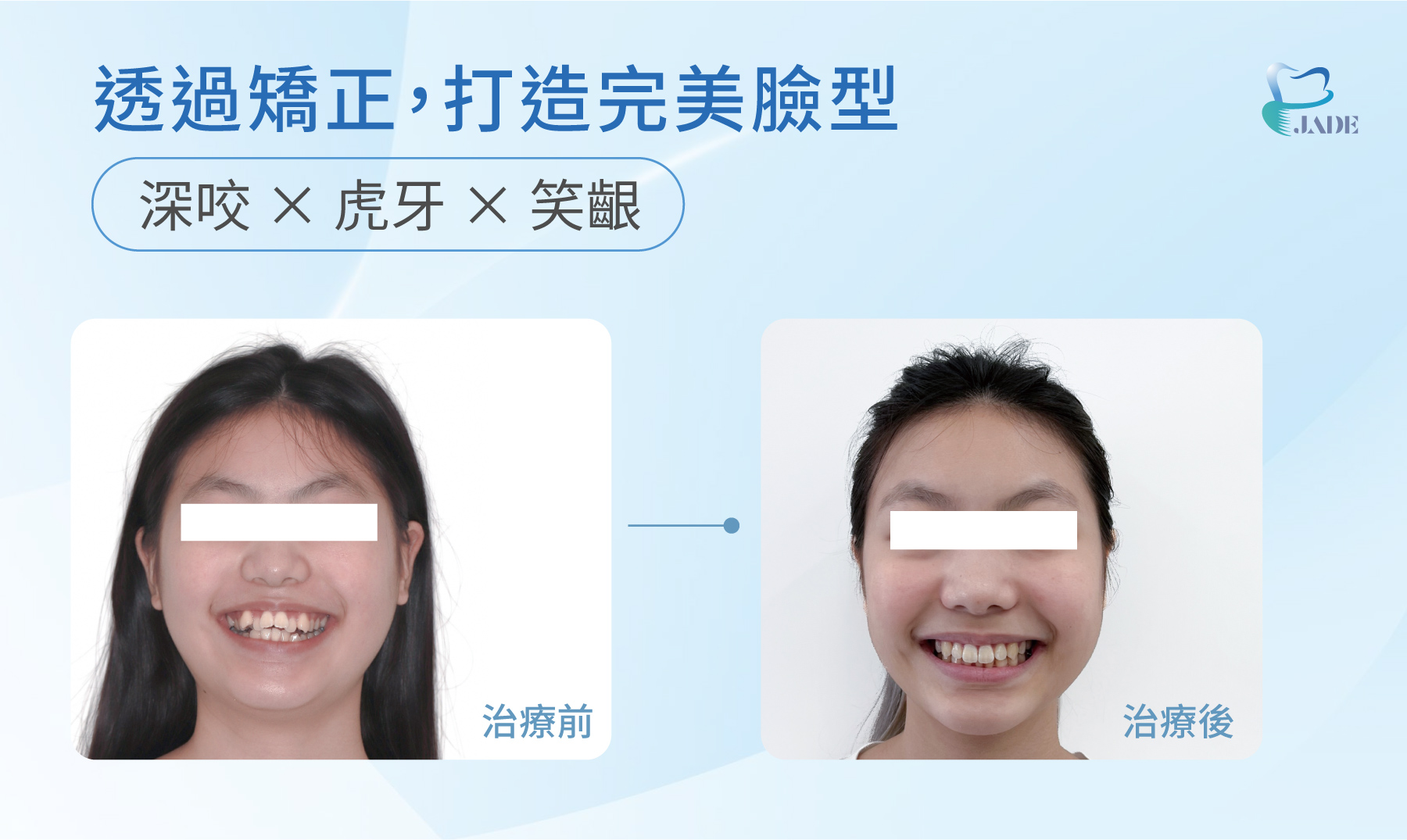 透過矯正，打造完美臉型，深咬、虎牙、笑齦治療前後的對比圖，從凌亂到整齊