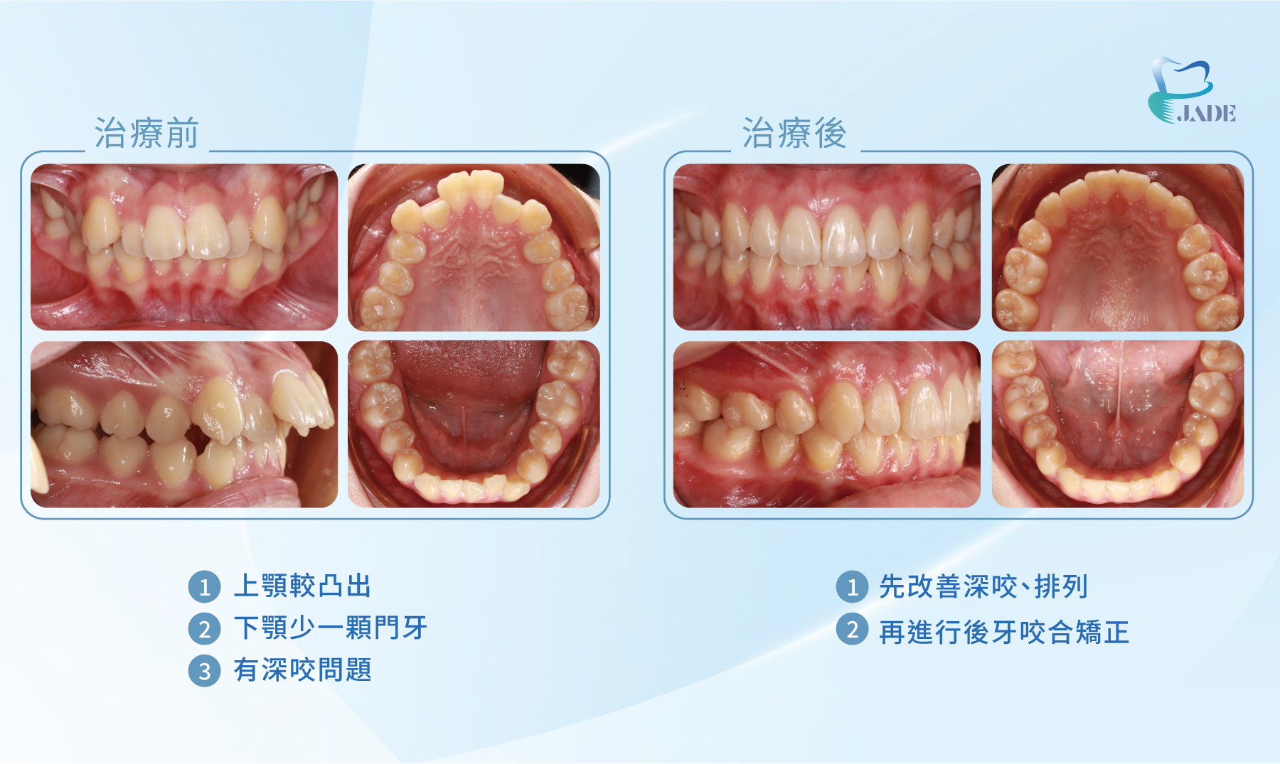 牙齒治療前有深咬問題，治療後排列整齊並修復後牙咬合矯正