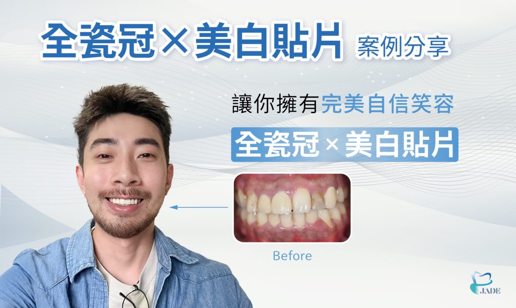 全瓷冠美白貼片案例分享,讓你擁有完美自信笑容