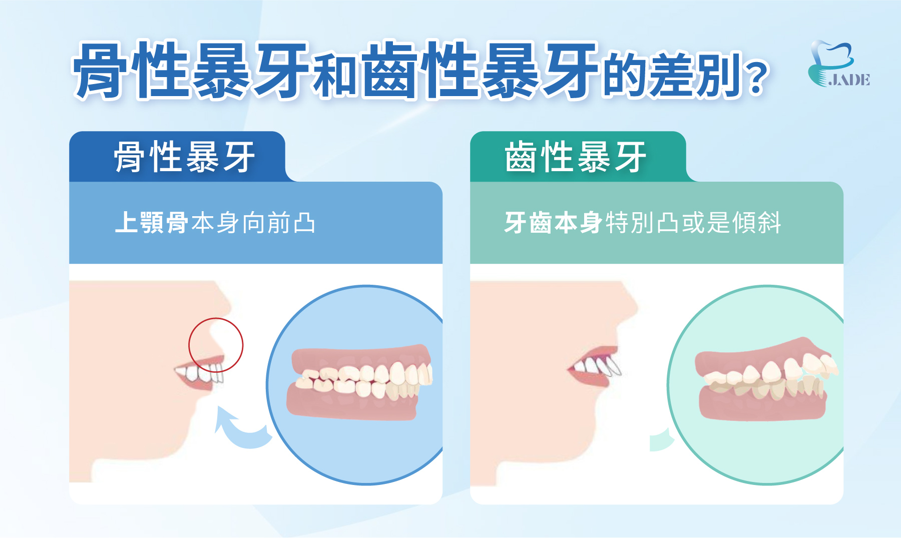 骨性暴牙和齒性暴牙的差別