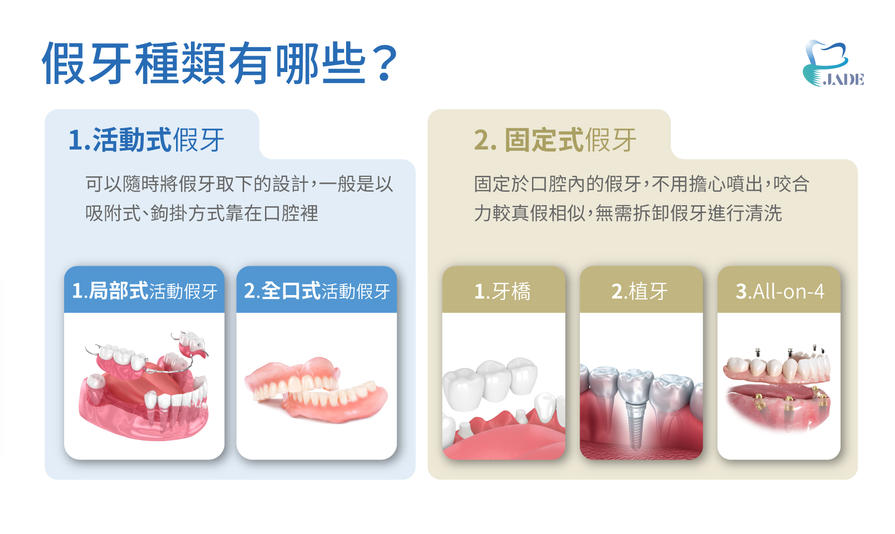 假牙種類有哪些？第一活動式假牙、第二固定式假牙