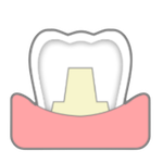 全瓷冠牙齒示意圖