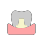 全金屬牙齒示意圖