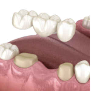 牙橋剖面示意圖,單顆/少顆相連缺牙