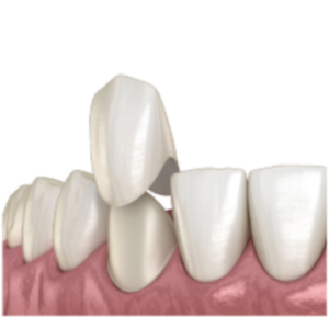 牙冠剖面示意圖，單顆缺牙/單顆牙齒受損