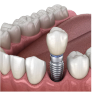 植牙牙齒剖面圖,單顆缺牙