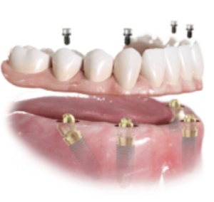All-on-4,多顆、單顎、全口缺牙