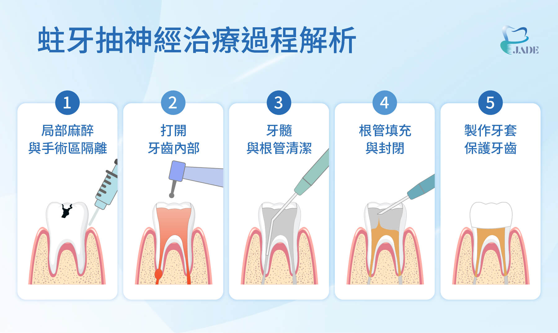 蛀牙抽神經治療過程解析