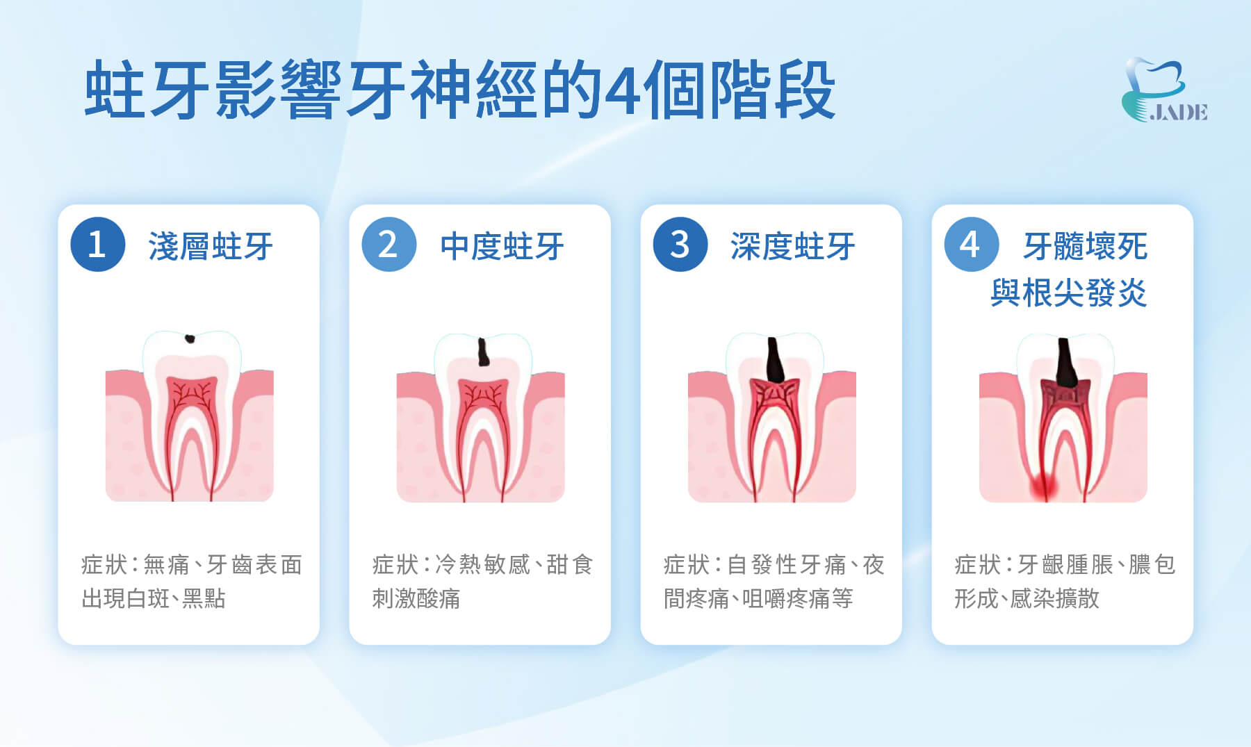 蛀牙影響牙神經的4個階段