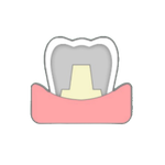 金屬燒瓷牙齒示意圖