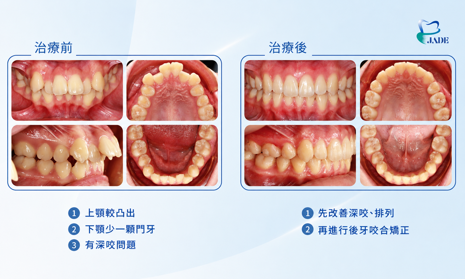 虎牙矯正治療前後對比牙齒對照圖