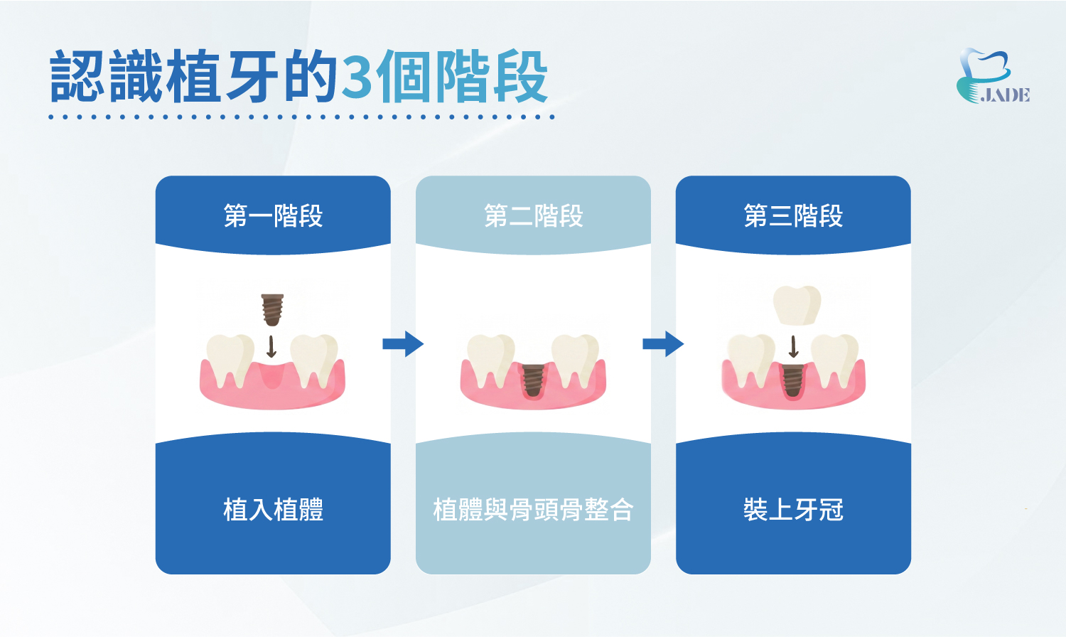 認識植牙的3個階段|玉美學牙醫診所