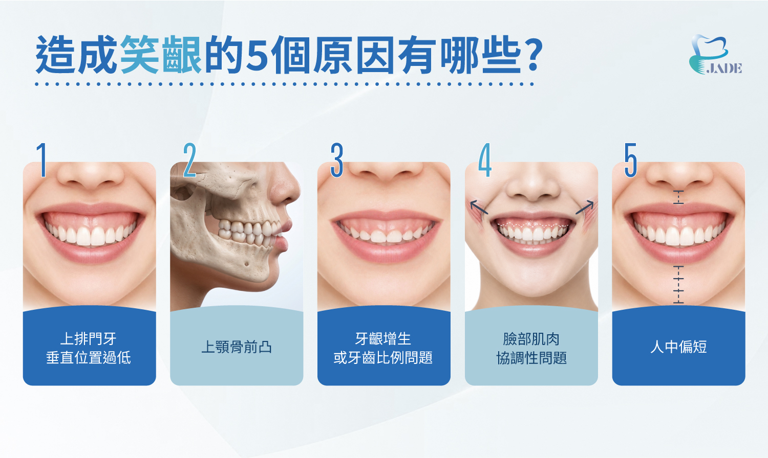 造成笑齦的5個原因有哪些?