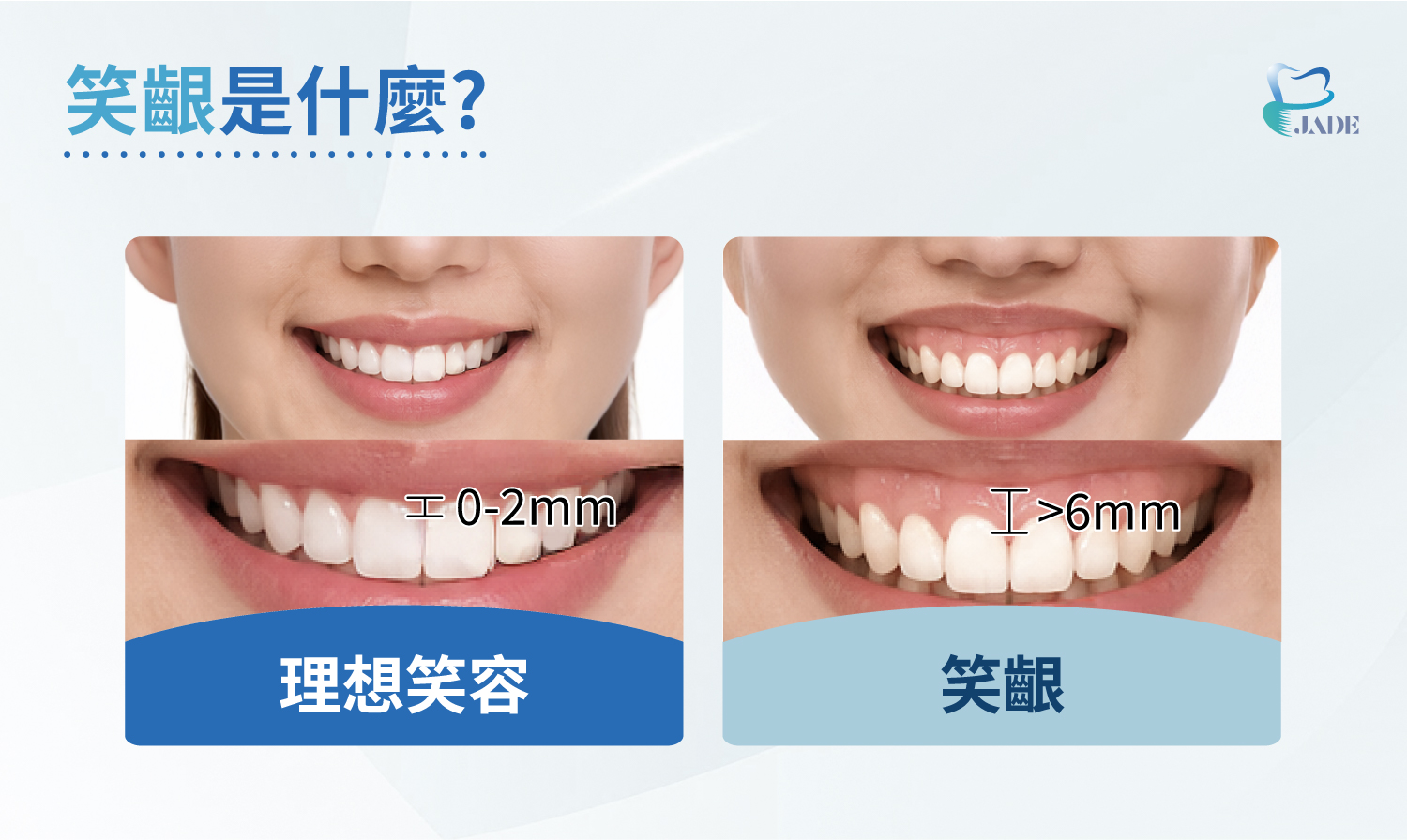 笑齦是什麼?
