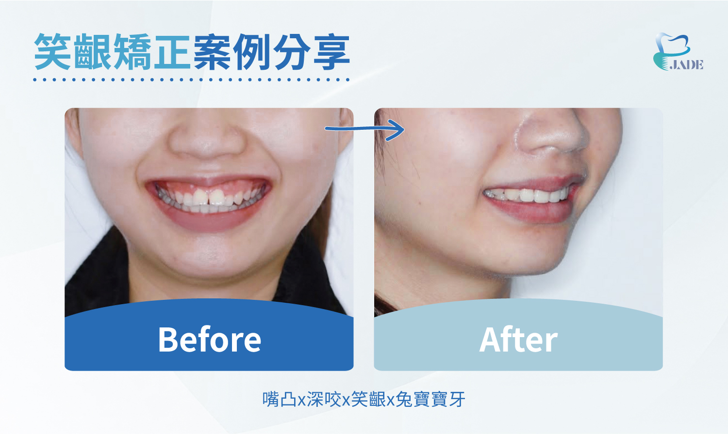 笑齦矯正案例BA圖:嘴凸深咬笑齦兔寶寶牙