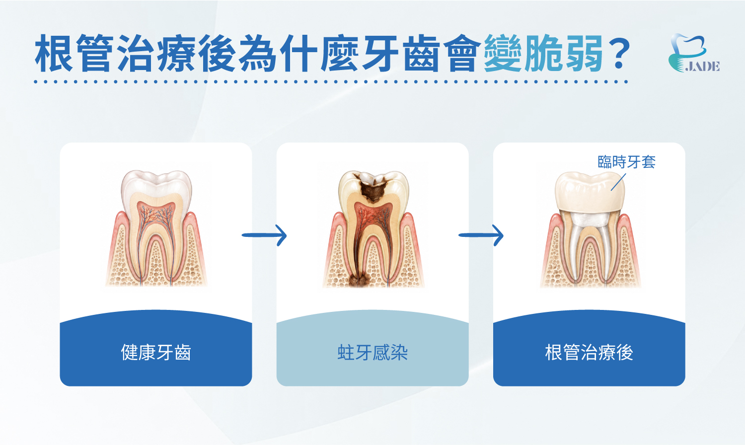 根管治療後為什麼牙齒會變脆弱？