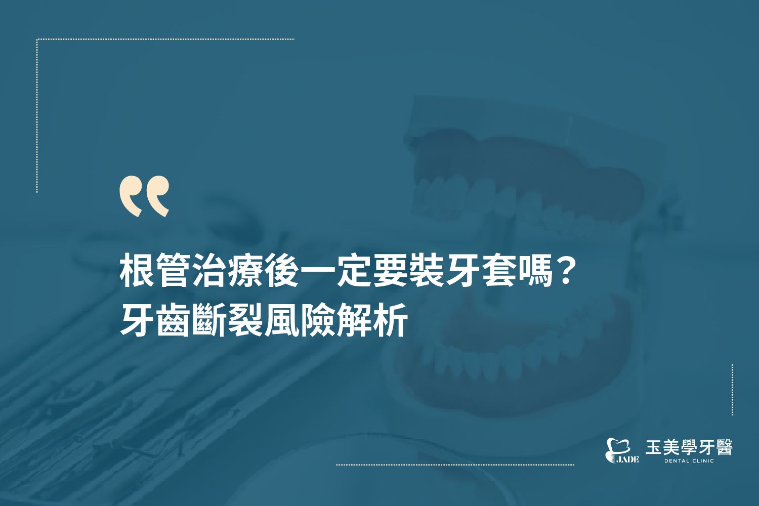 根管治療後一定要裝牙套嗎？牙齒斷裂風險解析